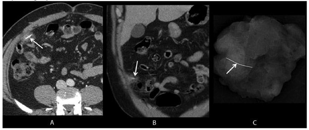 The figure consists of three images. The first two are axial and coronal images from intravenous contrast-enhanced computed tomography showing a wire grill-cleaning brush bristle in the omentum, surrounded by soft tissue stranding (inflammation). The third image is a specimen radiograph from omental resection that confirms complete foreign object removal.